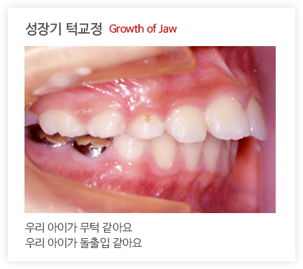 성장기 턱교정1 Growth of Jaw