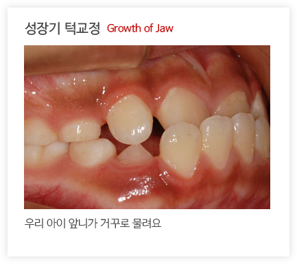 성장기 턱교정2 Growth of Jaw