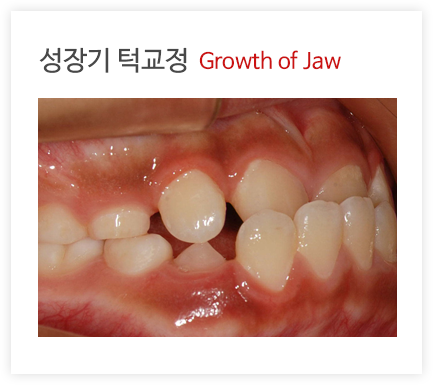 성장기 턱교정